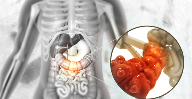Colectomy