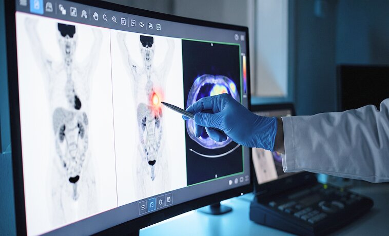 PET-CT