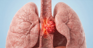 Esophageal-Surgery