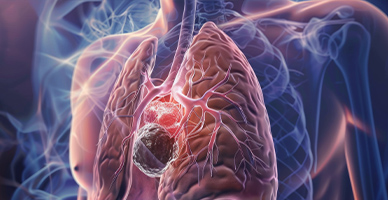 Pneumonectomy