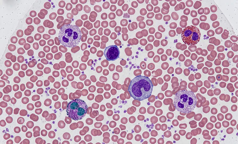 Peripheral Blood Smear