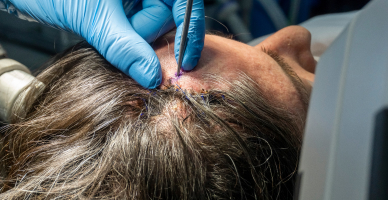 Laser Interstitial Thermal Therapy