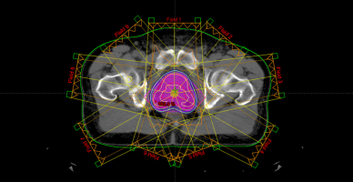 3D Conformal Radiation Therapy