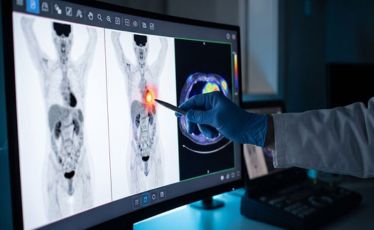 PET-CT