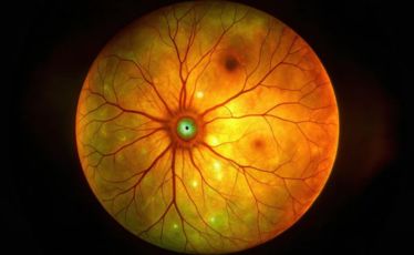 Eye Angiography