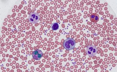 Peripheral Blood Smear