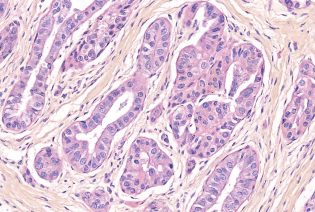 Invasive Ductal Carcinoma (IDC)