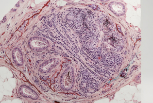 Invasive Lobular Carcinoma (ILC)