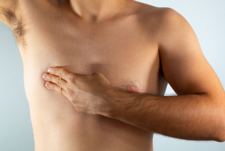 Male Breast Cancer