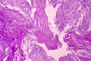 Paget's Disease of the Breast
