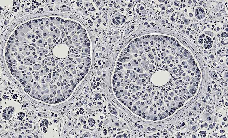 Vacuum-Assisted Breast Biopsy (VABB)