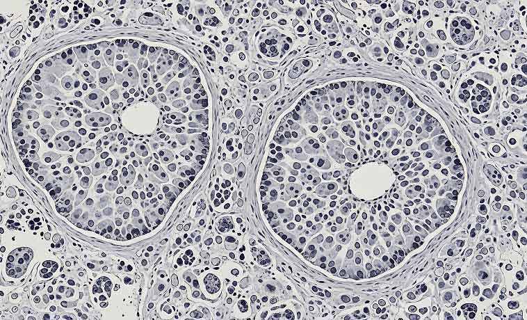 Vacuum-Assisted Breast Biopsy (VABB)
