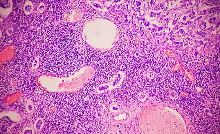 Fine-Needle Aspiration Cytology (FNAC)