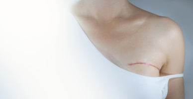 Latissimus Dorsi Flap Reconstruction