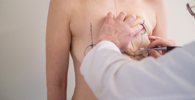 Nipple Reconstruction and Tattooing