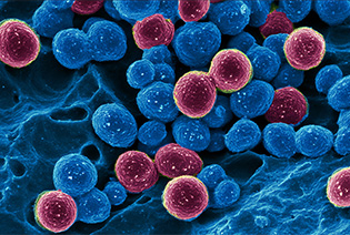 Ewing Sarcoma