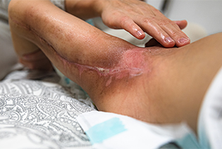 Rhabdomyosarcoma