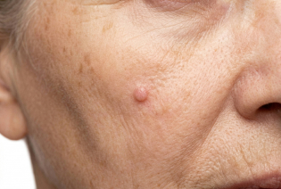 Basal Cell Carcinoma