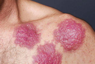 Cutaneous Lymphoma
