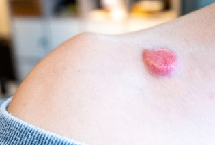 Dermatofibrosarcoma Protuberans