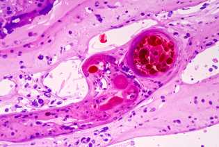 Kaposi Sarcoma