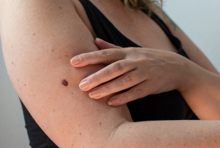 Melanoma