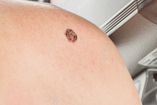 Squamous Cell Carcinoma
