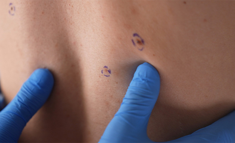 Excisional Biopsy