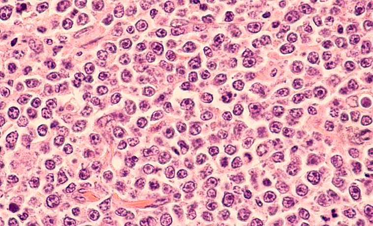 Lymph-Node Biopsy
