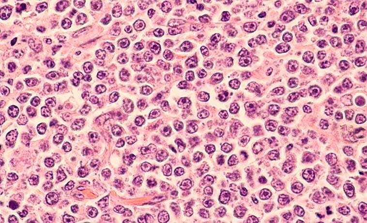 Lymph-Node Biopsy