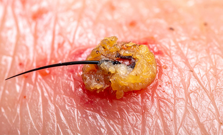 Punch Biopsy
