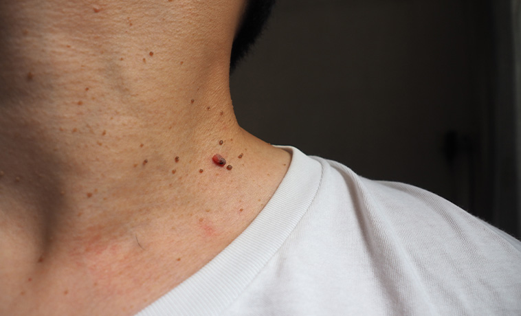 Shave Biopsy
