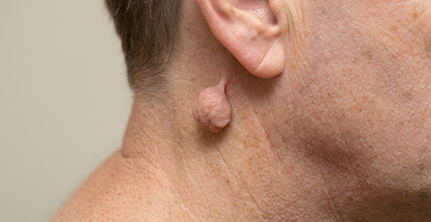 Local Flap Reconstruction