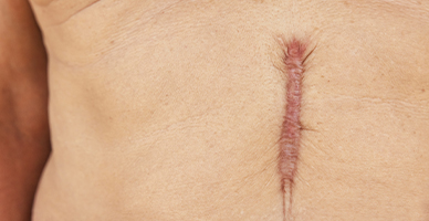 Regional or Free-Flap Reconstruction