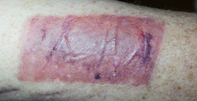 Skin Grafting