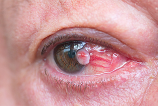 Conjunctival Squamous Cell Carcinoma