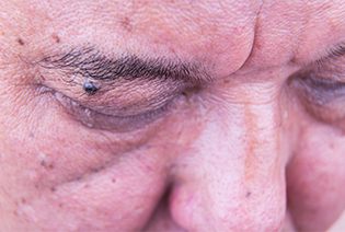 Eyelid and Orbital Cancers