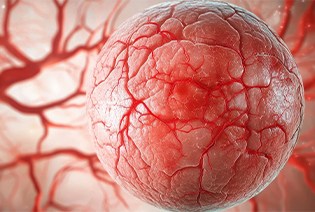 Metastatic Eye Cancer