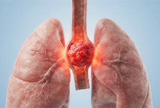 Esophageal Cancer