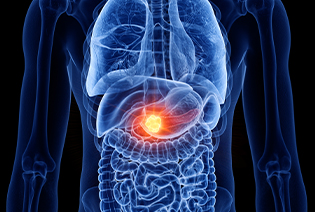 Pancreatic Cancer