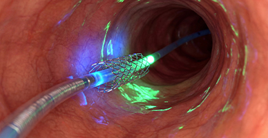 Biliary and Enteric Stenting