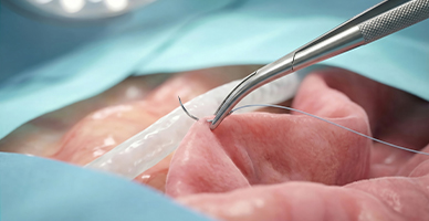 Pancreatic Reconstruction