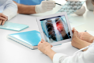 Pulmonary Neuroendocrine Tumours