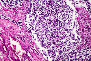Small Cell Lung Cancer