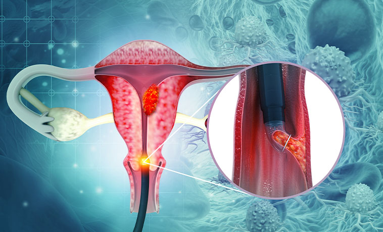 Hysteroscopy and Dilatation and Curettage