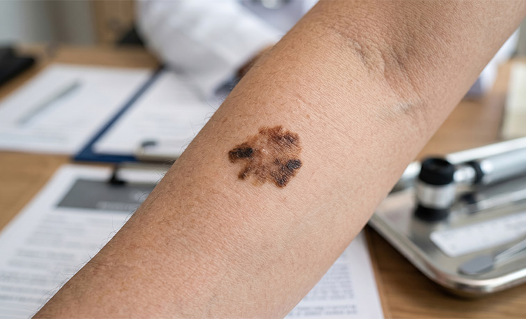 Image-Guided Biopsy