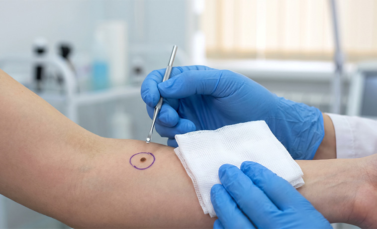 Surgical Biopsy