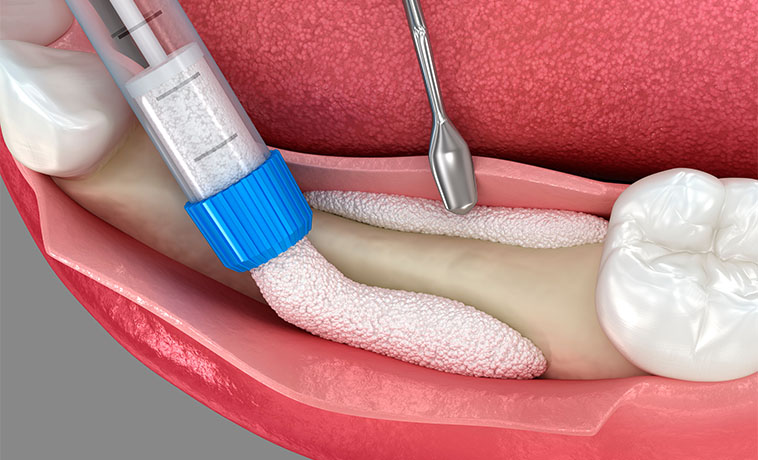 Abdominal-Wall Reconstruction