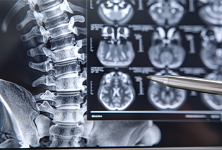 Brain and Spinal Tumours