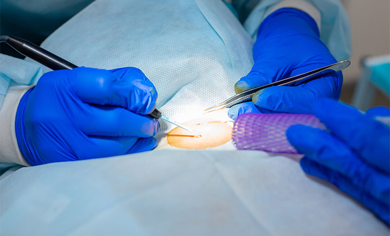 Surgical Biopsy
